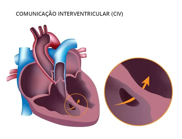 infográfico de comunicação interventricular