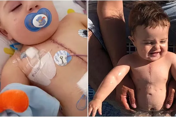 recuperação da cirurgia cardiovascular infantil-recuperacao