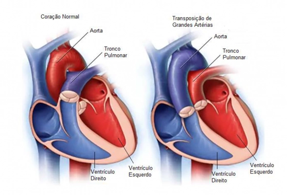transposição das grandes artérias