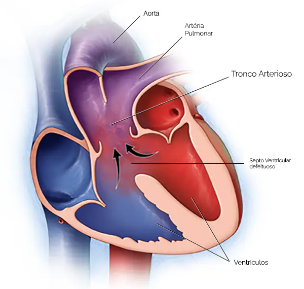 tronco arterioso comum